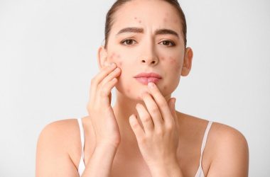 Uncommon Tactics: Riding Off Pimples with Unique Strategies